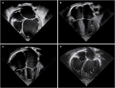 Overview of Cardiomyopathies in Childhood